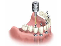 Best root canal & laser Specialist in Bhopal