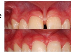 Best dental implant centre in bhopal