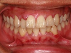 Best dental implant centre in bhopal