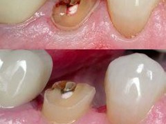 Best dental implant centre in bhopal