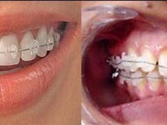 Best dental implant centre in bhopal