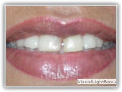 Best dental implant centre in bhopal