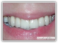 Best dental implant centre in bhopal