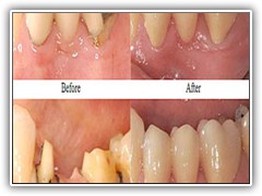 Best dental implant centre in bhopal