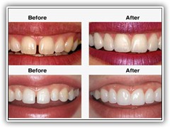 Best dental implant centre in bhopal