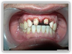 Best root canal & laser Specialist in Bhopal