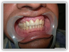 Best dental implant centre in bhopal