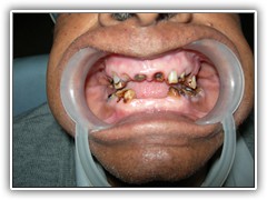 Best root canal & laser Specialist in Bhopal