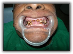 Best dental implant centre in bhopal