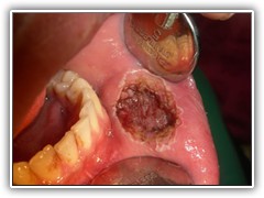 Best dental implant centre in bhopal