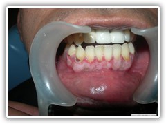Best dental implant centre in bhopal