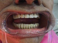 Best dental implant centre in bhopal