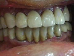 Best root canal & laser Specialist in Bhopal