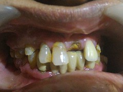 Best root canal & laser Specialist in Bhopal