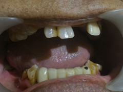 Best dental implant centre in bhopal