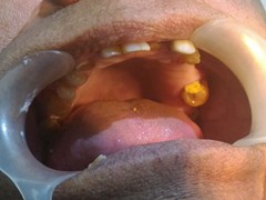 Best root canal & laser Specialist in Bhopal