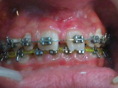 Best dental implant centre in bhopal