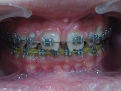 Best dental implant centre in bhopal