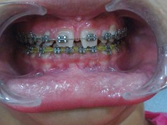 Best dental implant centre in bhopal